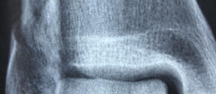 artritis